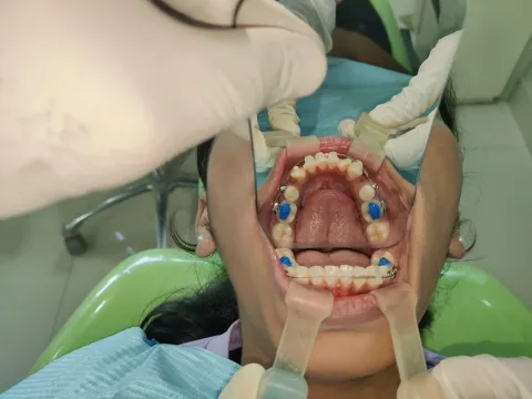 Orthomania orthodontic training for general dentists, Chembur Mumbai, photo 231